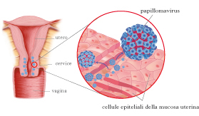 trasmissione papilloma virus papillary urothelial cell proliferation