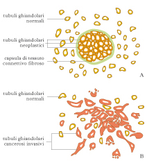 adenocarcinoma