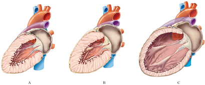 scompenso cardiaco