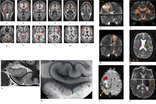 imaging cerebrale, diagnosi e ricerca